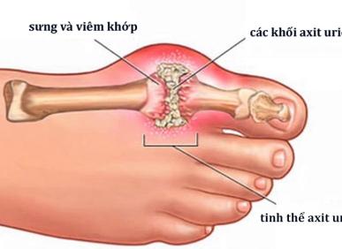 Lợi &iacute;ch của nước ion kiềm với bệnh gout