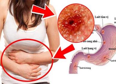 Nước kho&aacute;ng gi&agrave;u bicarbonate gi&uacute;p điều trị bệnh vi&ecirc;m lo&eacute;t dạ d&agrave;y